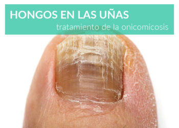 tratamiento-hongos-en-las-unas-onicomicosis-farmacia-online