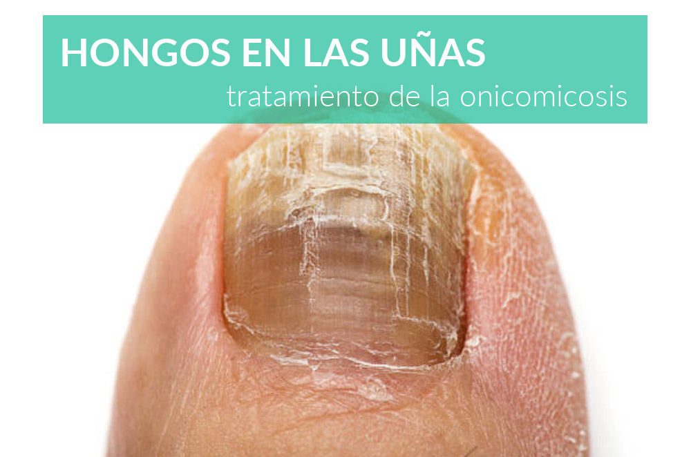 tratamiento-hongos-en-las-unas-onicomicosis-farmacia-online